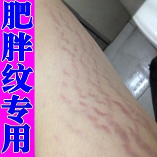 去肥胖纹修复消除去肥胖纹生长纹妊辰纹大腿纹身体乳淡化男女通用