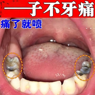 牙龈脓包牙根发炎肿包儿童牙根肿痛消炎喷雾牙肉增生周炎上火