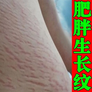 去肥胖纹修复霜生长纹消除大腿学生屁股淡化去除男精油青少年膏