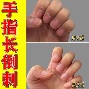指甲修复液手指倒刺营养油护理去刺神器防止儿童手上长边缘干裂霜