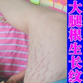 去肥胖纹修复膏生长纹消除大腿孕后妊辰娠肥胖纹膨胀纹橘皮纹乳膏