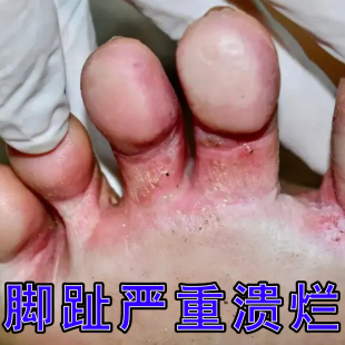 脚趾严重溃烂烂脚丫专用膏脚趾缝糜烂瘙痒脚缝开裂疼痛杀菌止痒药