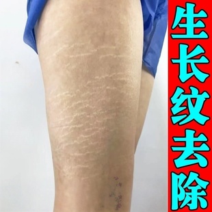 去肥胖纹生长纹修复霜大腿学生腰肚皮肥胖纹去除男女通用