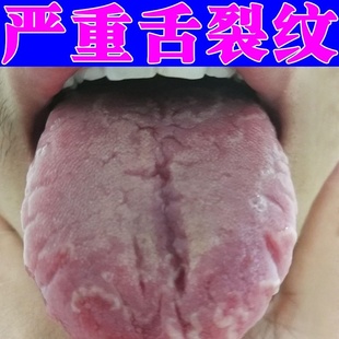 地图舌调理儿童舌头裂痕地图舌裂纹舌齿痕灼口综合症舌发白发厚麻