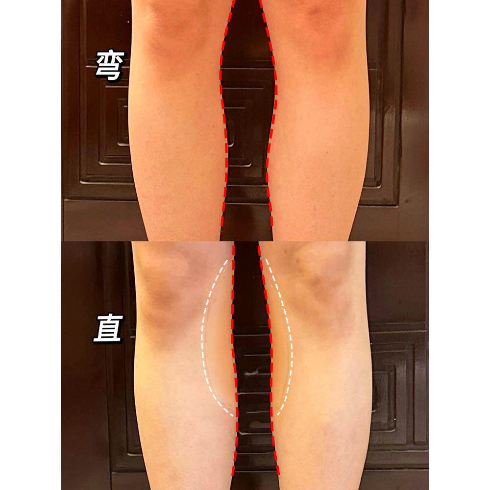 直腿硅胶贴腿型矫正直腿神器贴成人弯腿xo型腿贴腿不直修饰小腿贴