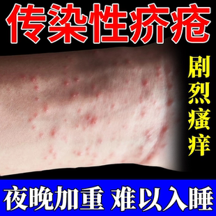 传染性疥疮阴杀疥虫皮肤瘙痒消毒杀菌止痒结节医用专用硫磺软膏RW