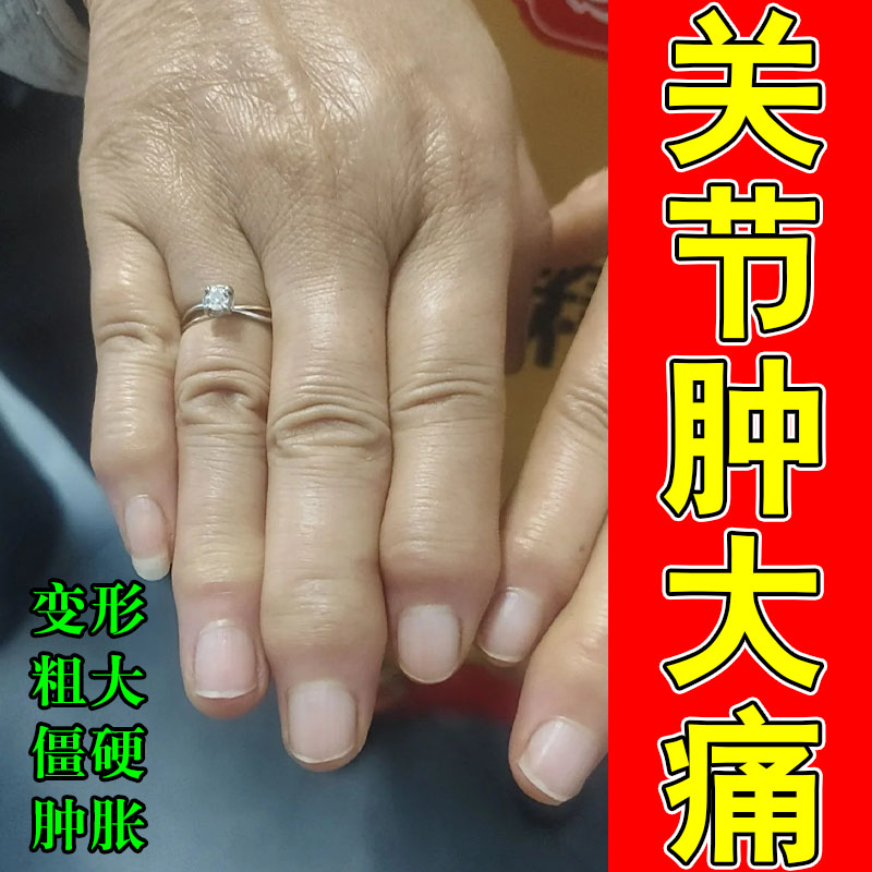 手指头关节肿大粗糙软膏改善骨节鼓包僵硬弯曲困难胀痛草本专用膏