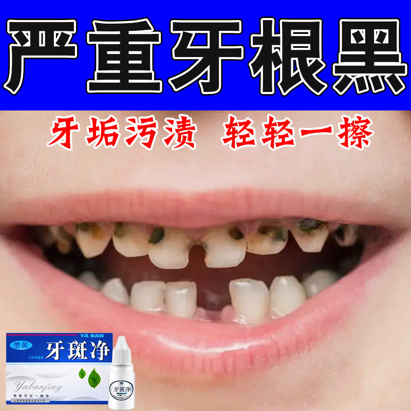 针对牙齿窝沟缝隙黑渍改善牙面黑线维护口腔洁净清洁修护液