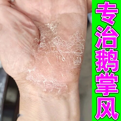 鹅掌有风专用手掌脱皮干裂手指关节起皮干燥发痒小水泡抑菌止痒膏