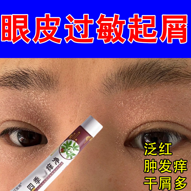 眼皮红肿起皮痒眼睛周围过敏粗糙发痒干燥起皮神经性保湿草本乳膏