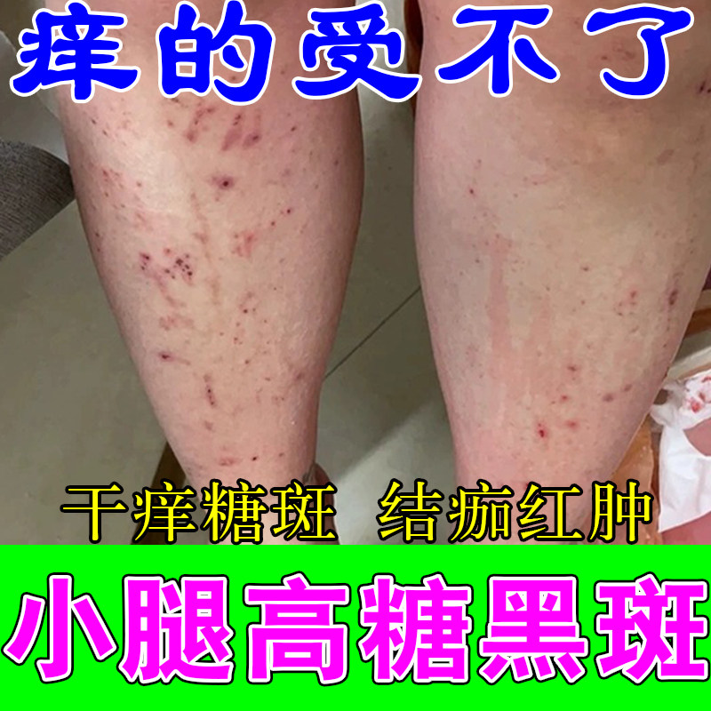 老人高糖肤质色素暗沉斑块全身皮肤干燥脱皮刺痒腿疼足疼草本膏