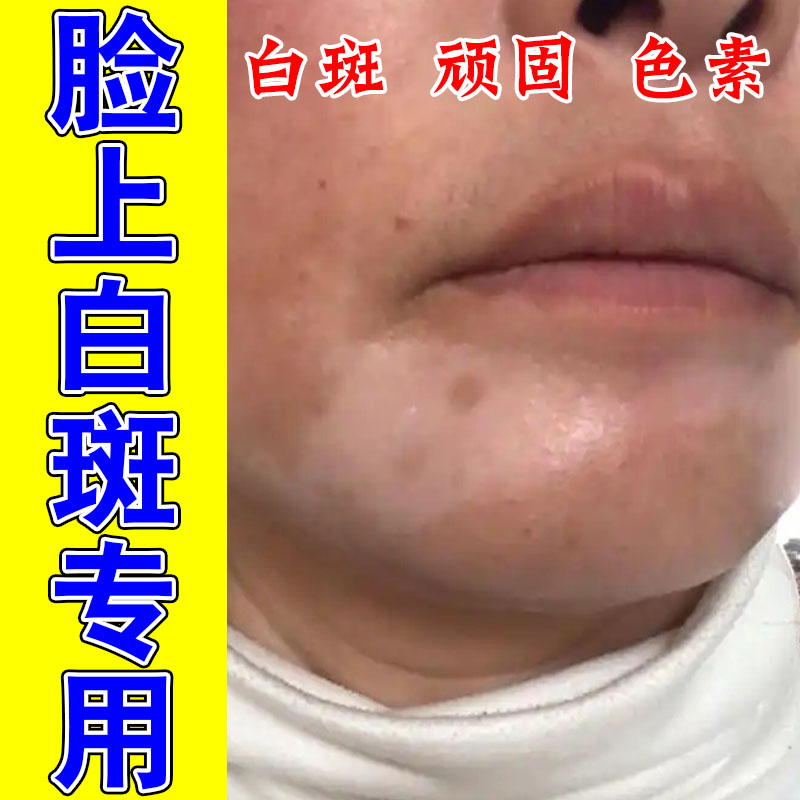 脸上长白斑成人脸上有小白点白块白斑修护黑色素生长草本膏