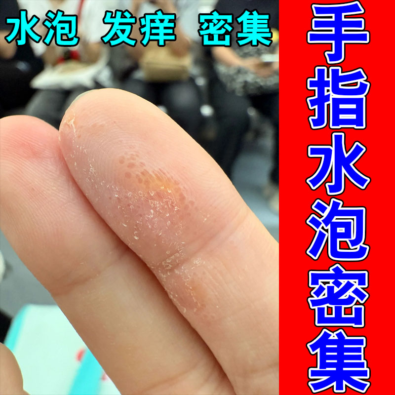 手指掌心长透明水泡颗粒疙瘩出汗发痒粗糙脱皮温和修护保湿膏