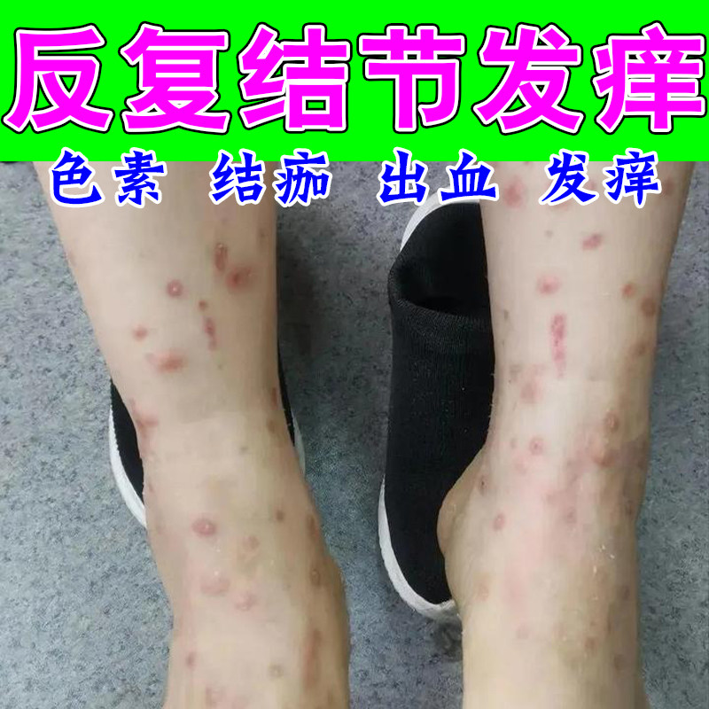 冶结节性顽固红硬疙瘩腿上全身疙瘩发痒红肿结痂修护草本膏