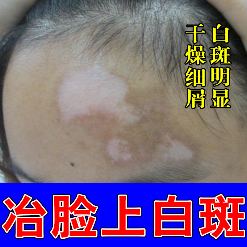 脸上长白斑白块成人脸部额头有小白点缺少黑色素汗斑修护膏