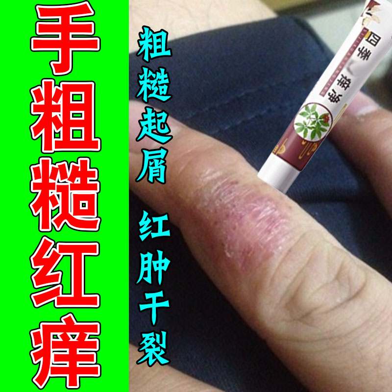 手指关节真菌指手指关节干裂痒指节膏指关节手指关节干燥屑发痒膏