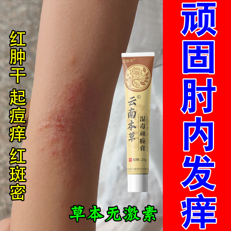 过敏特应性疙瘩手肘窝痒胳膊肘内侧起水泡疙瘩红点皮肤保湿软膏