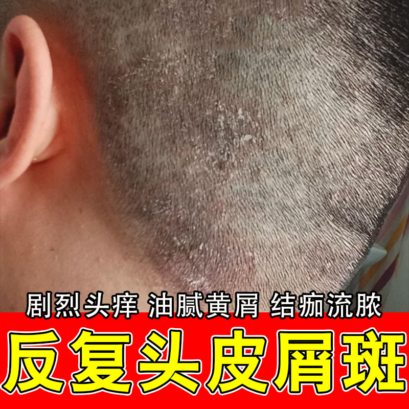 冶头皮大片白屑结痂起皮干燥粗糙发痒泛红肿痒草本萃取修护膏乳