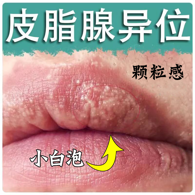 皮脂腺异位嘴唇白点小颗粒润唇膏