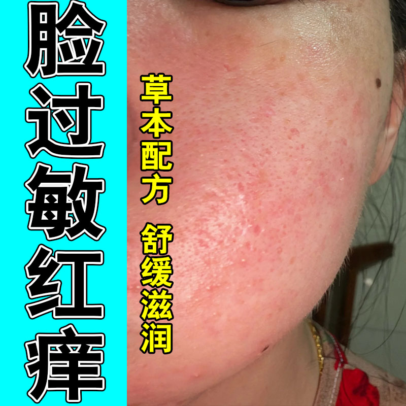 脸部肌肤干痒起皮面部发红刺痛不适草本精华舒缓保湿膏