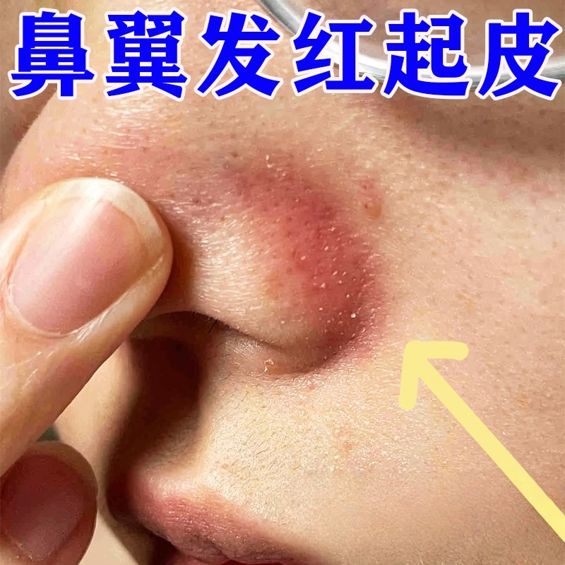 鼻子两侧起皮泛红脱皮发红鼻翼两边泛红干燥修复长痘痘痒膏酒糟鼻