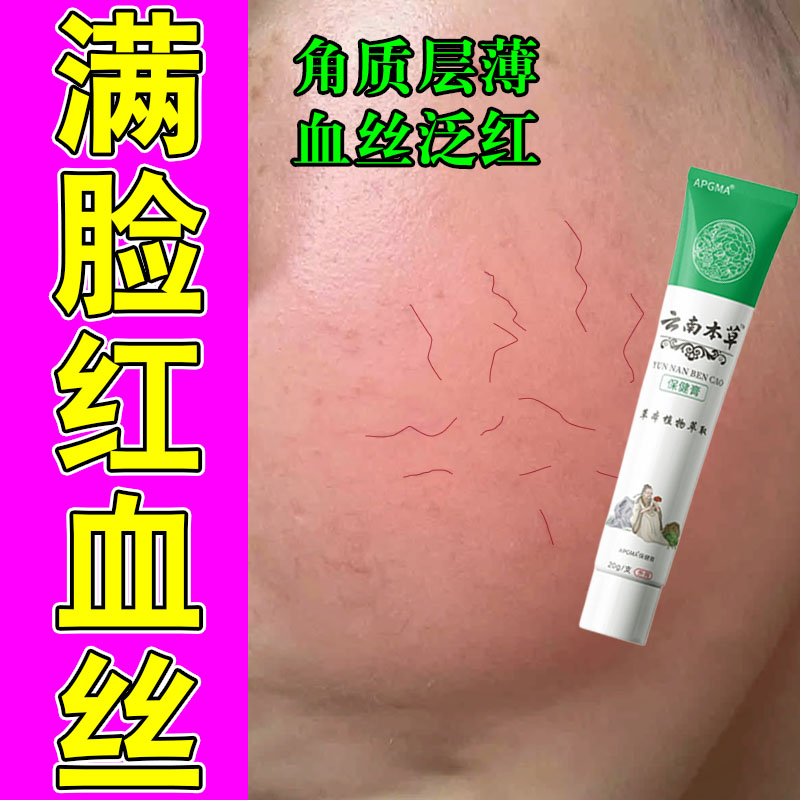 脸上红血丝严重脸上红血丝泛红角质层薄过敏长红血丝草本修护乳膏