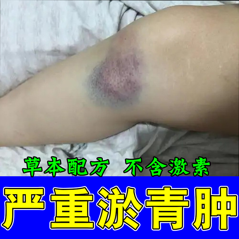 去腿上淤青消活血化瘀膝盖摔磕碰撞伤发紫疼跌打损伤草本软膏