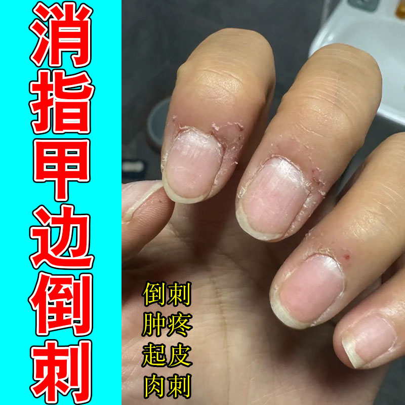 手指起倒刺手足脱皮肉刺手指头起皮肉刺出血儿童指甲边缘修护保湿
