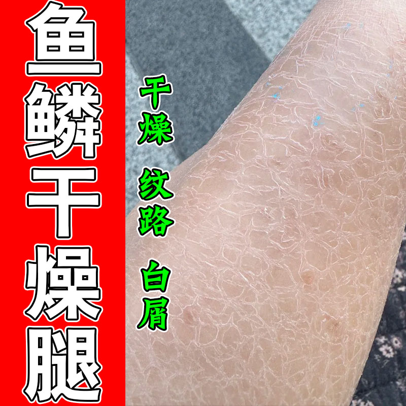 腿部肌肤干燥起皮鱼鳞状掉皮屑改善粗糙裂纹保湿滋养舒缓甘油