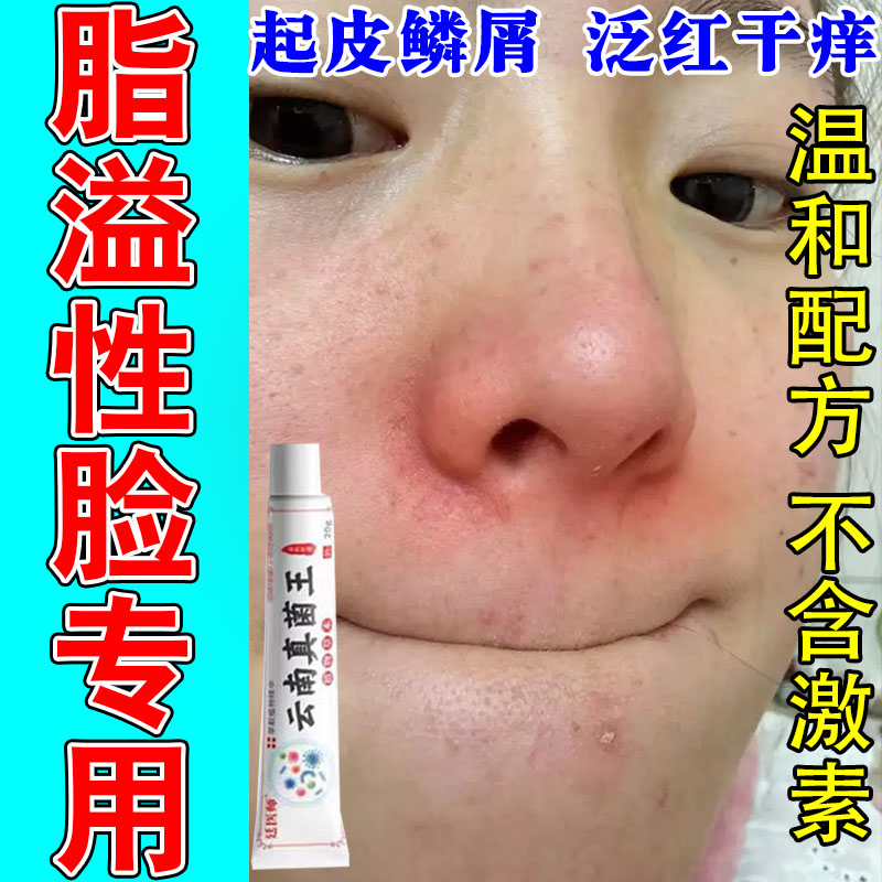 冶鼻侧脂溢性皮肤发红燥起皮两边泛红干燥起皮脂溢性皮痒红修护膏