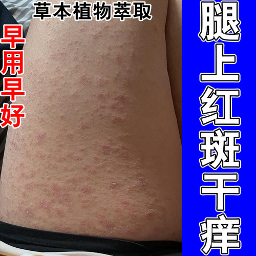 玫瑰红斑皮肤痒过敏红斑起皮干燥起皮红点粗糙痒涂抹修护软膏