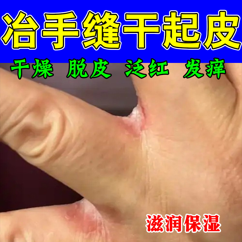 手指缝脱皮痒手指间起皮渗水发白碰水发红脱皮起干皮开裂疼痛膏