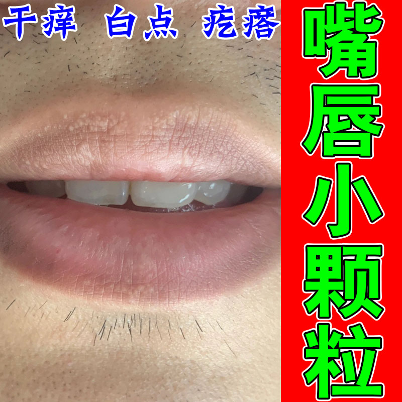 嘴唇白点疙瘩水泡皮脂腺异位脂肪小颗粒增唇周暗沉草本修护软膏
