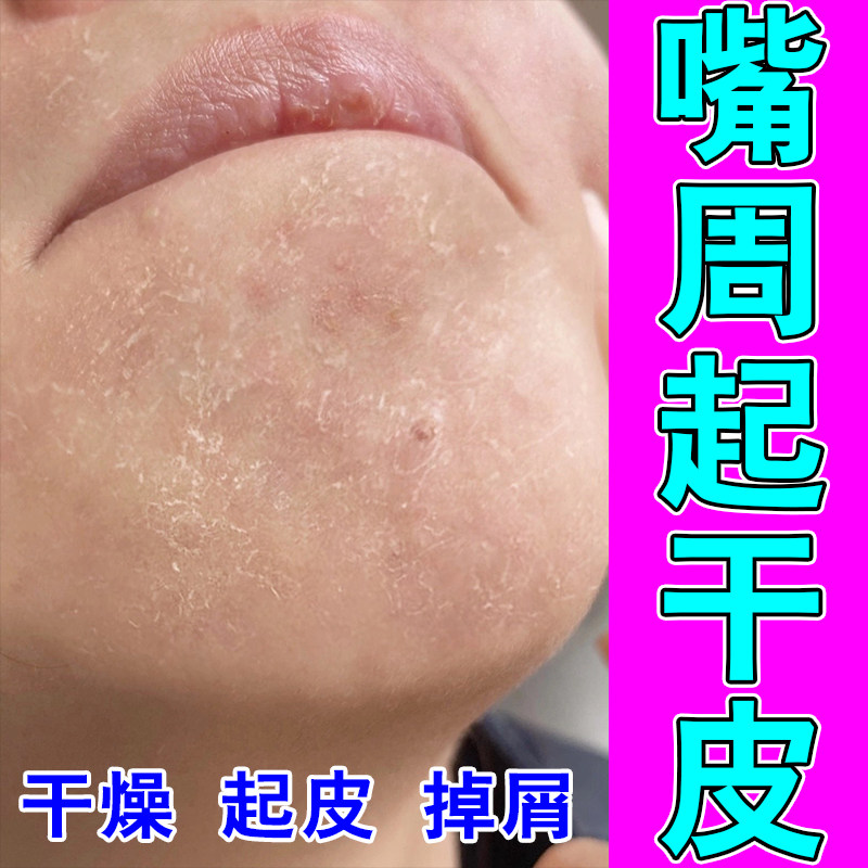 面部干痒脱皮泛红敏感肌嘴角皮屑干燥刺痛缓解干燥补水修护甘油