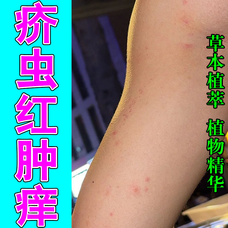 手脚腋下小水泡痒虫螨疙瘩红痒泛红刺痛植物萃取温和修护软膏