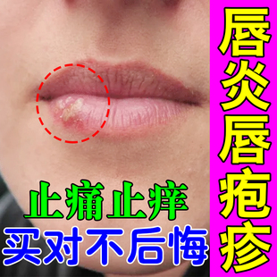 嘴巴上火起泡痒烂嘴角嘴唇疱疹红肿结痂单纯疱疹干燥起皮疼痛滋润