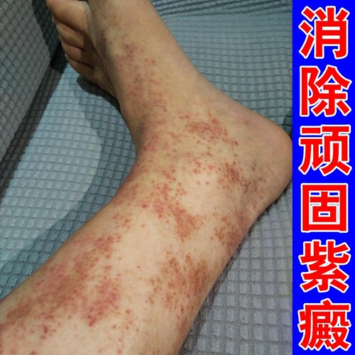 紫癜特药效皮下出血红点老年性皮炎血管炎儿童小孩单纯性紫癜软膏