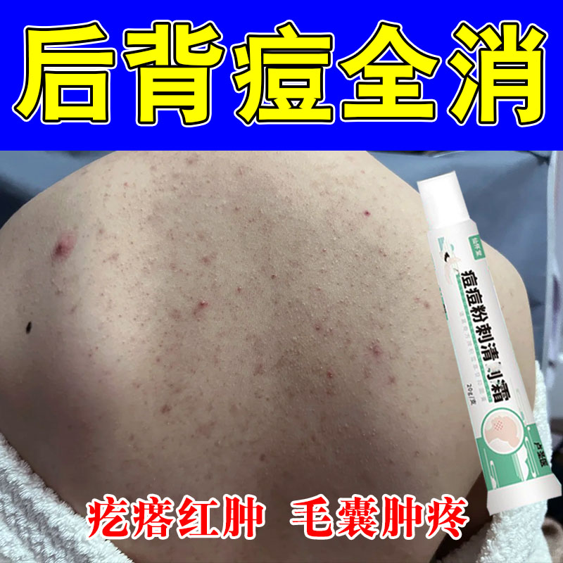 后背疙瘩痘内分泌痘胸上毛囊后背马色拉菌痘疙瘩红肿疼修护植物膏