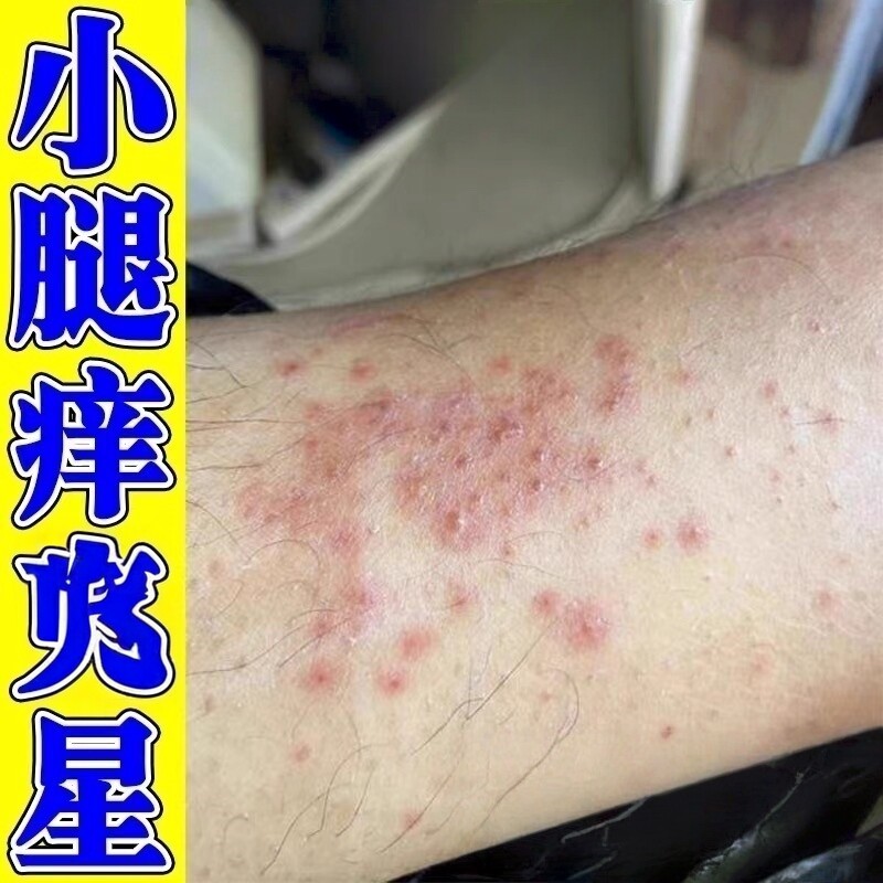 腿痒小腿皮肤干燥痒起皮小红点疙瘩秋冬春夏天热冶腿痒红疙瘩