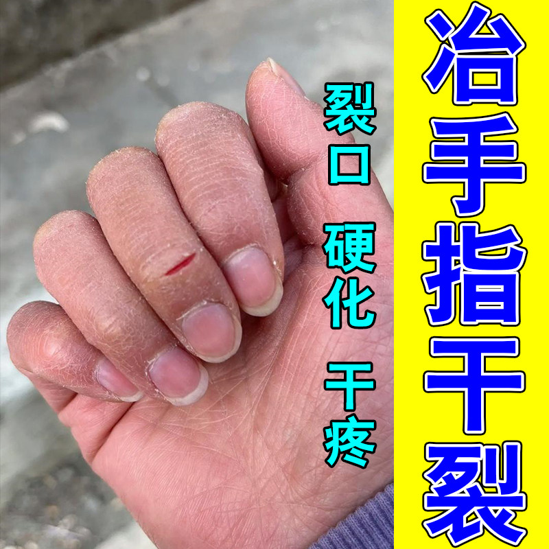 手裂口子干燥粗糙爆干皮手指头脱皮掉屑疼起硬皮红肿保湿修护膏