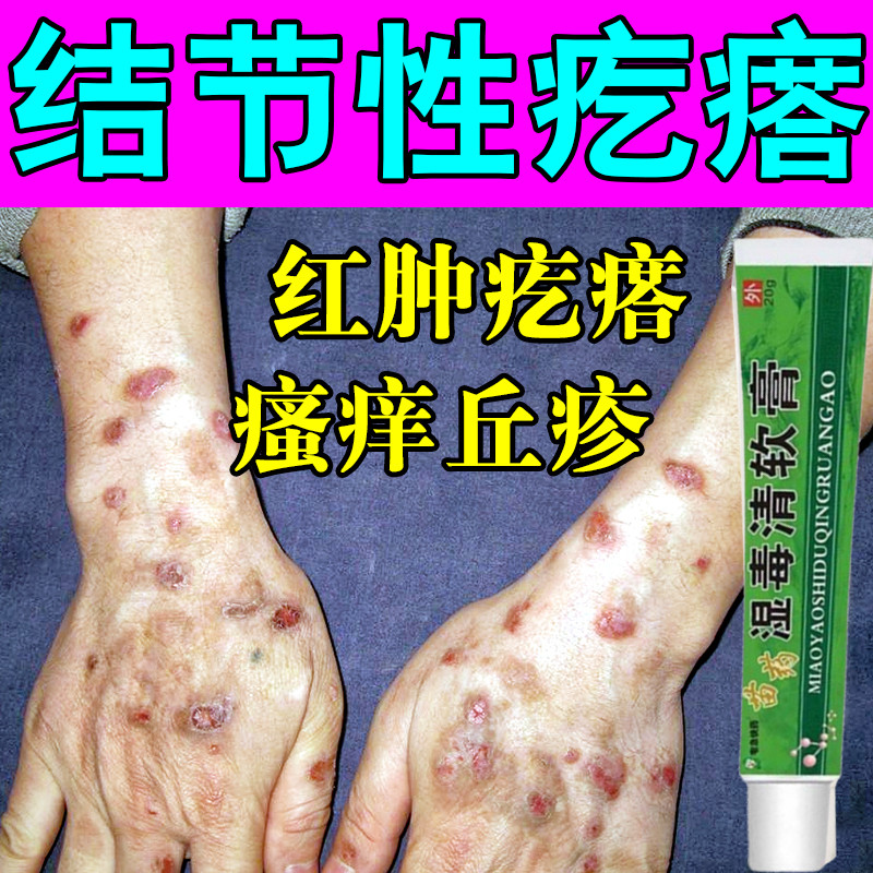 结节性痒疹特效治顽固硬疙瘩胳膊皮肤红肿瘙痒止痒全身丘疹疙瘩药