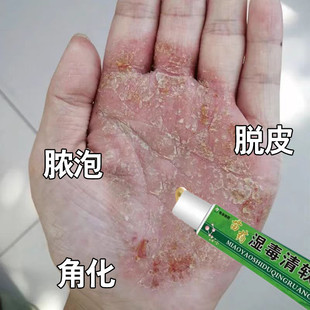 掌趾脓疱病症掌治疗手脚脓包角化病水泡脱皮干裂掌跖脓疱外用乳膏