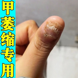 儿童啃咬指甲修复甲床生长液指甲萎缩受损再生甲床短小分离空甲药