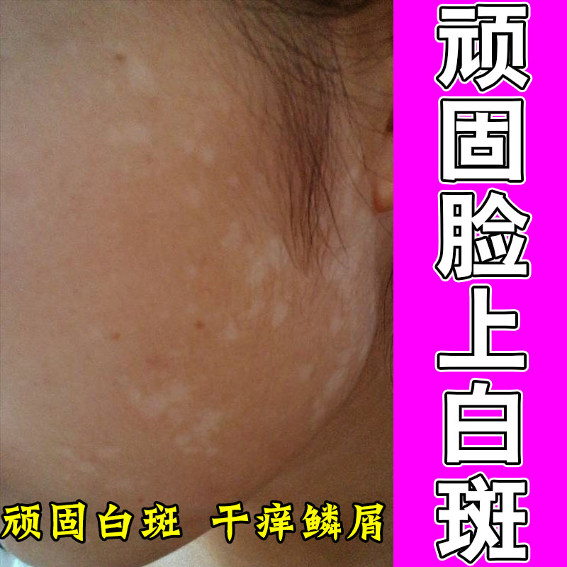额头长白斑成人脸上长小白块快速白斑儿童白色汗斑花斑草本膏乳