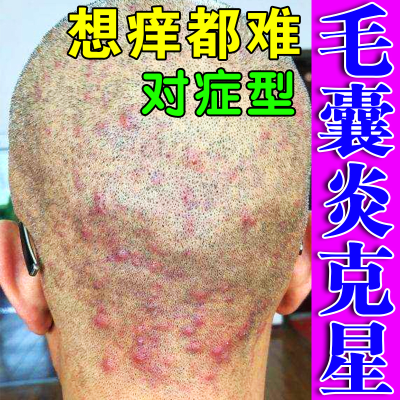 头皮毛囊炎专用头上长痘痘痒有疙瘩脓包红肿疼治后脑勺脂溢性皮痒