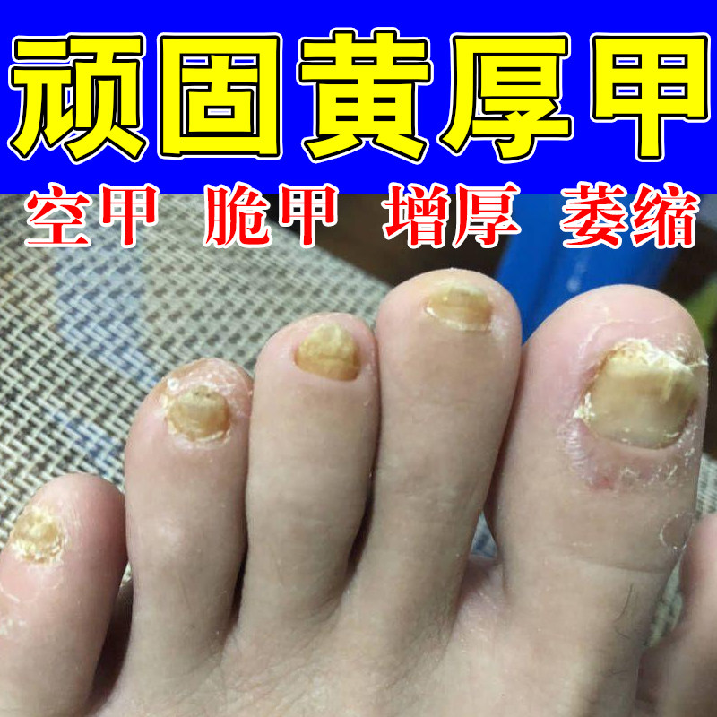 成人脚指甲增厚变黄指甲黄用脚趾甲变厚指甲盖发黄变硬修护指甲液