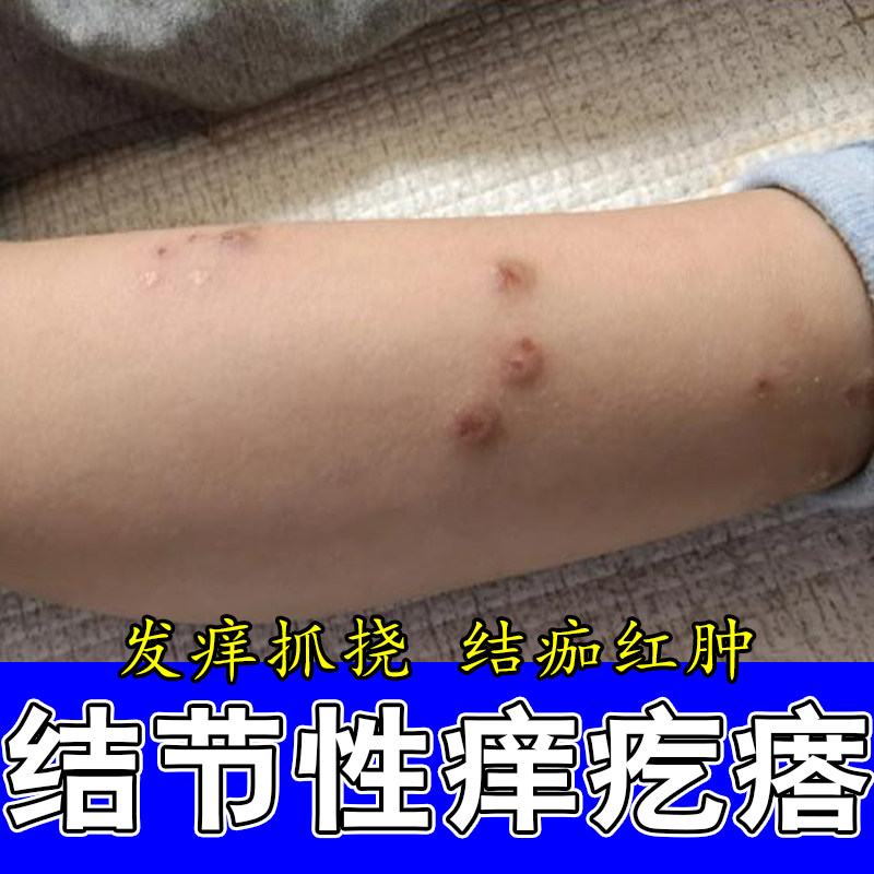冶结节性痒顽固红硬疙瘩皮肤疙瘩小腿皮肤痒草本修护软膏