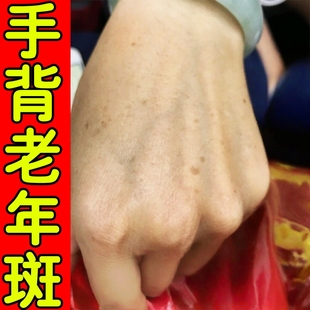老年斑强力去除手背黑斑黄褐斑日晒黑点太阳斑手部黑色素沉淀专用