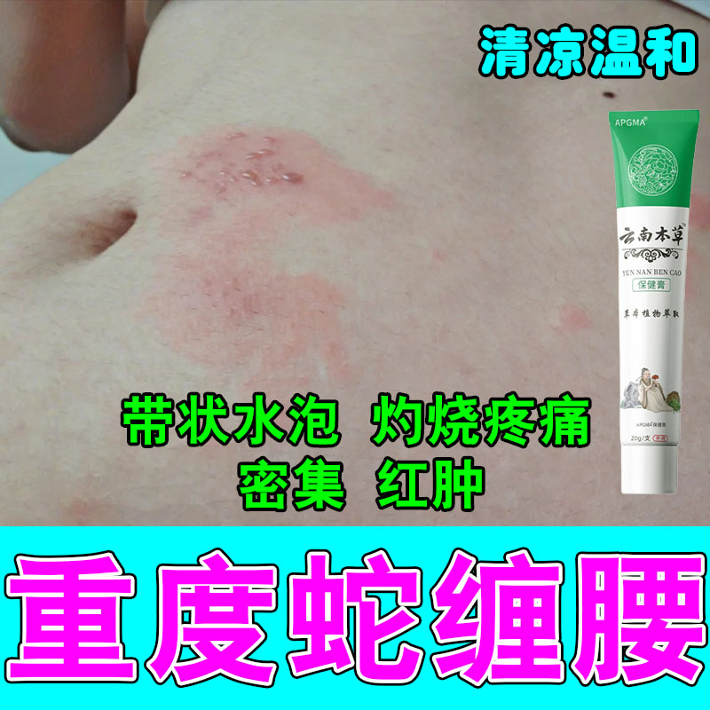 腰上起带状小泡汗缠腰中药真菌痒疙瘩肿刺痛草本修护专用膏