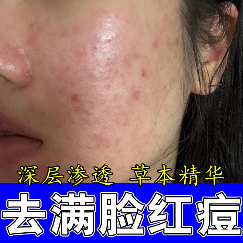 成人脸上起疙瘩红肿疼干燥脸上红肿硬疙瘩起皮修护舒缓软霜